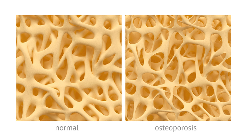 kosť s normálnou stavbu a so stavbou pri osteoporóze